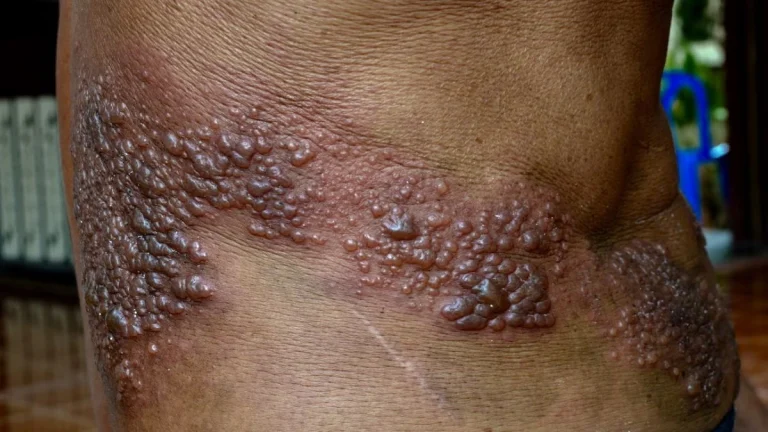 Shingles: Recognizing the Symptoms
