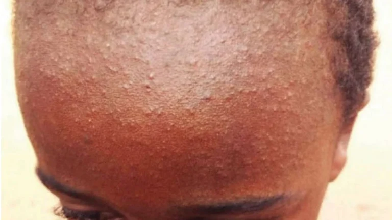 Parents Urged to Act Now: Protect Your Child Against Measles and Rubella