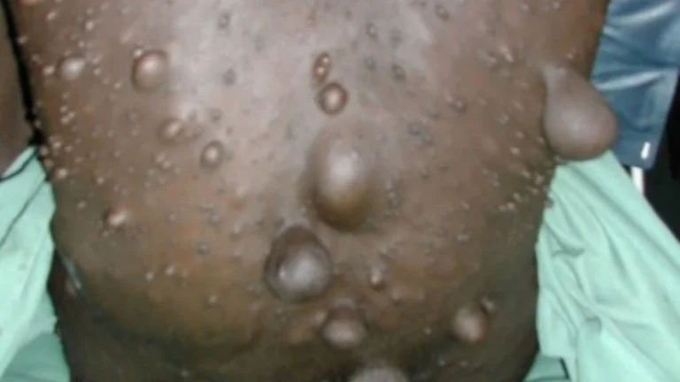 What is Neurofibromatosis? Understanding the Condition and Recognising Symptoms